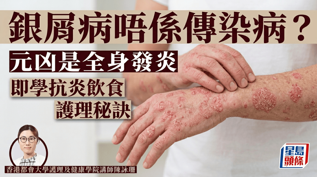 銀屑病不是傳染病？元凶是免疫系統失調全身發炎 即學抗炎飲食/護理秘訣