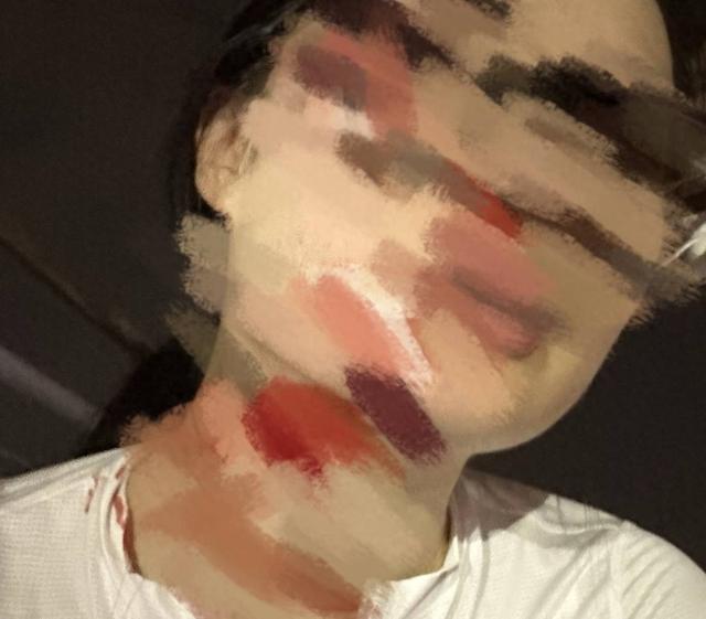 女子騎行遭魚線絆倒,面部身上多處受傷。封面新聞 女子騎行遭魚線絆倒,面部身上多處受傷。封面新聞