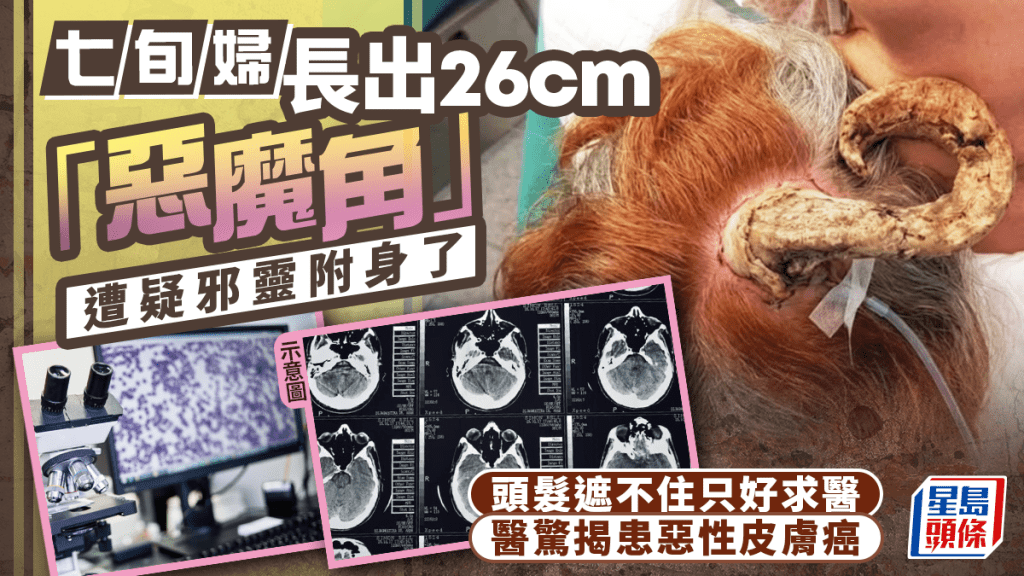 泰老婦後腦長26厘米「惡魔角」 親友疑遭邪靈附身 醫驚揭患皮膚癌