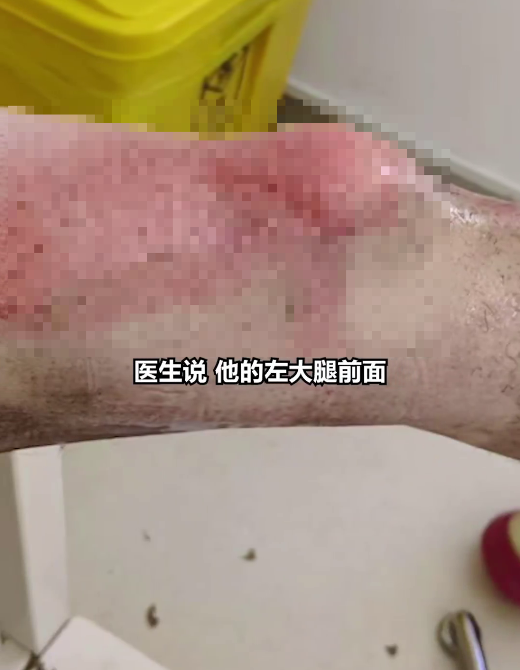 上海一男子褲袋羅馬仕「尿袋」自燃,致腿部三級燒傷,需植皮。 後浪視頻 上海一男子褲袋羅馬仕「尿袋」自燃,致腿部三級燒傷,需植皮。 後浪視頻
