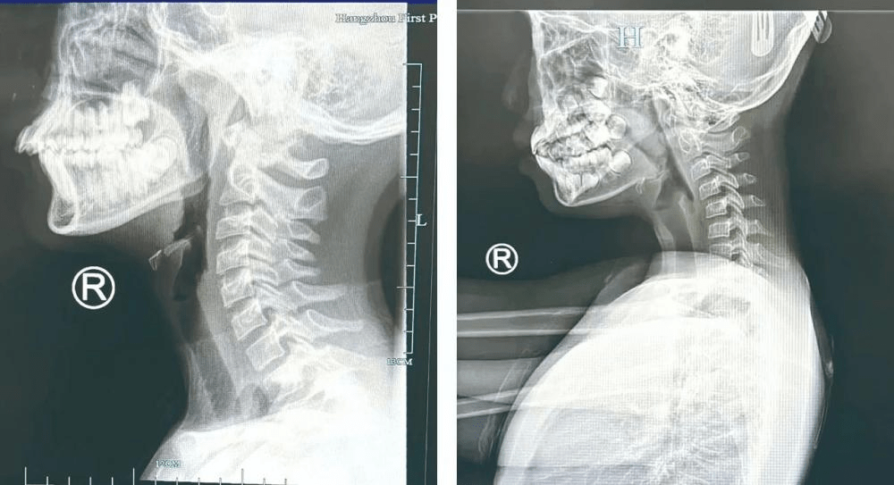 左為正常頸椎，應呈「C形」，右為頸椎呈直線，甚至反弓。