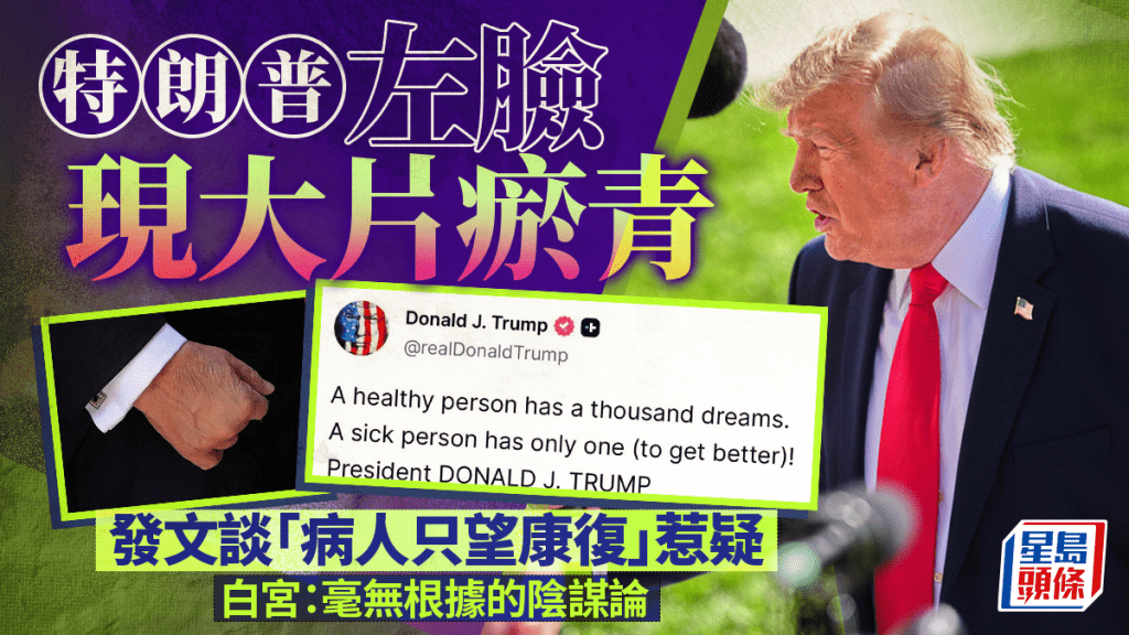 特朗普太陽穴突現不明瘀青  發文談「病人只望康復」惹猜疑