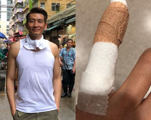 袁文傑的尾指暫時不能屈曲，網友都叫他日後開工要小心啲！