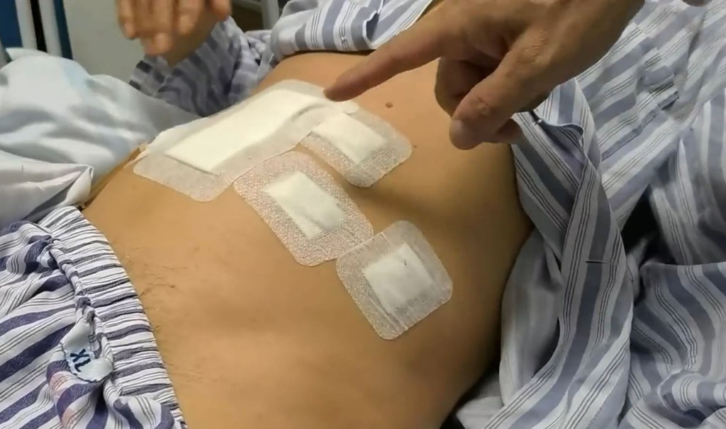 深圳有老翁膀胱藏有逾1200粒結石，情況罕見。新京報