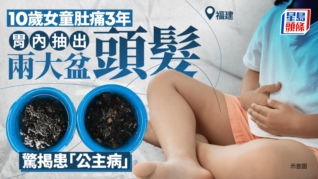 異食癖｜10歲女童「公主病」肚痛3年 胃中取出兩大盆頭髮