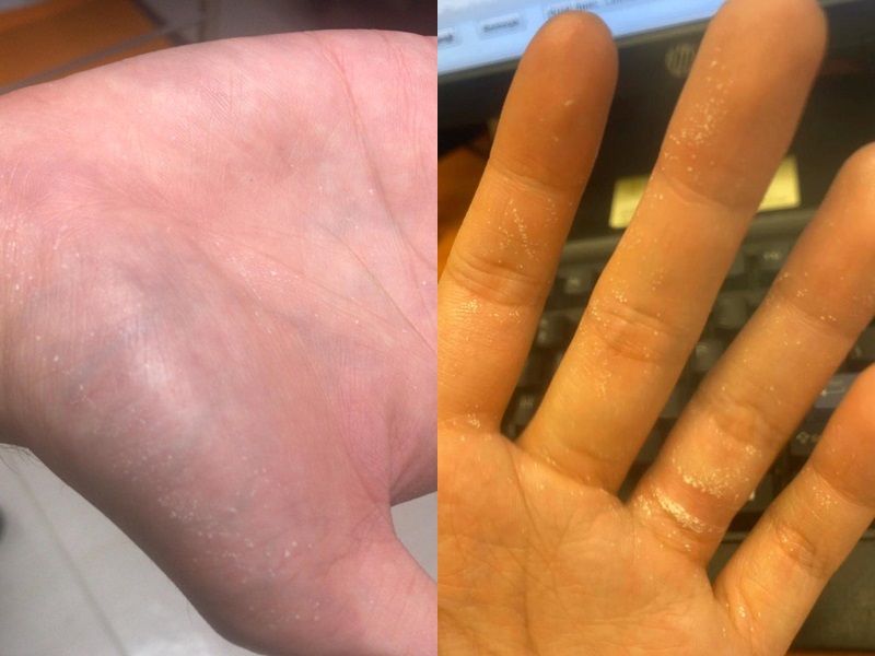 醫護使用消毒手液後出現白點。