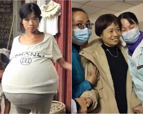 貴州巨肚媽媽手術後成功回復正常人的體重。網圖