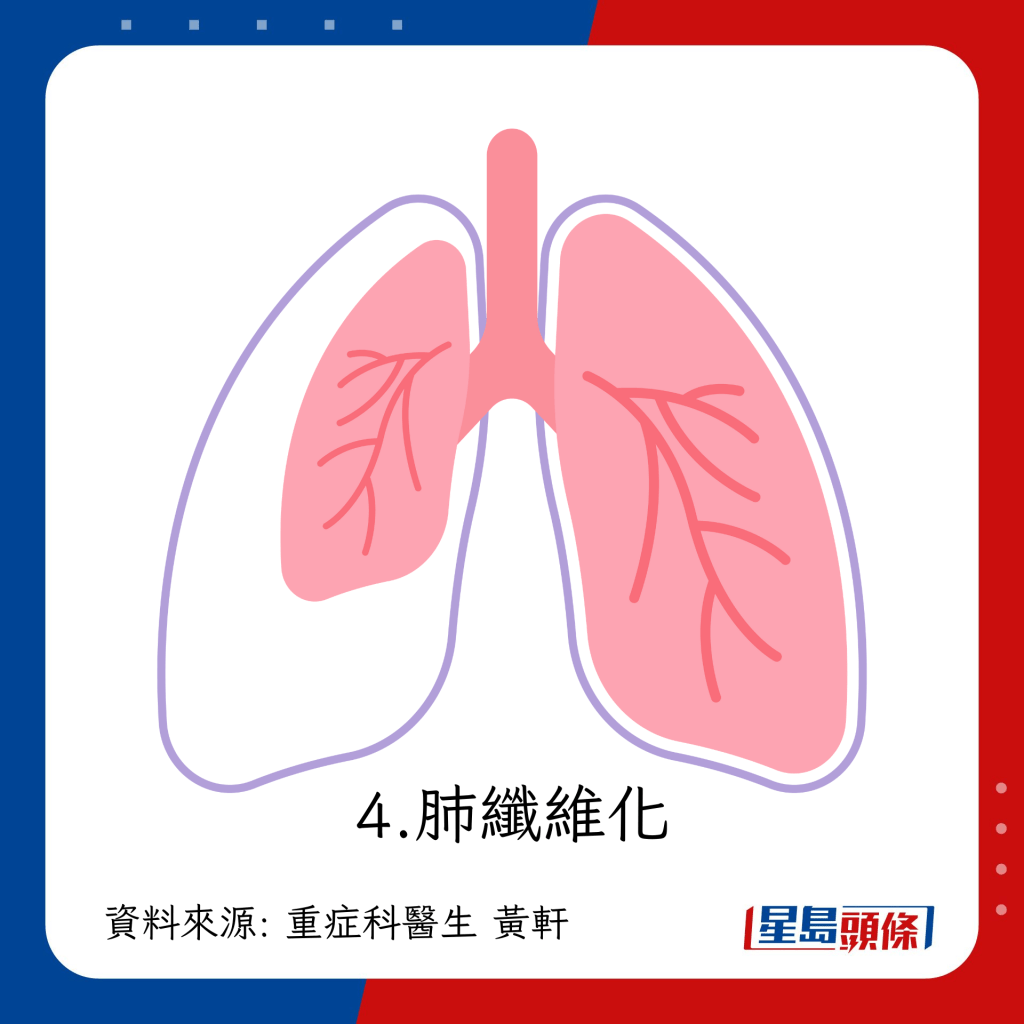 持续咳嗽可能患肺纤维化