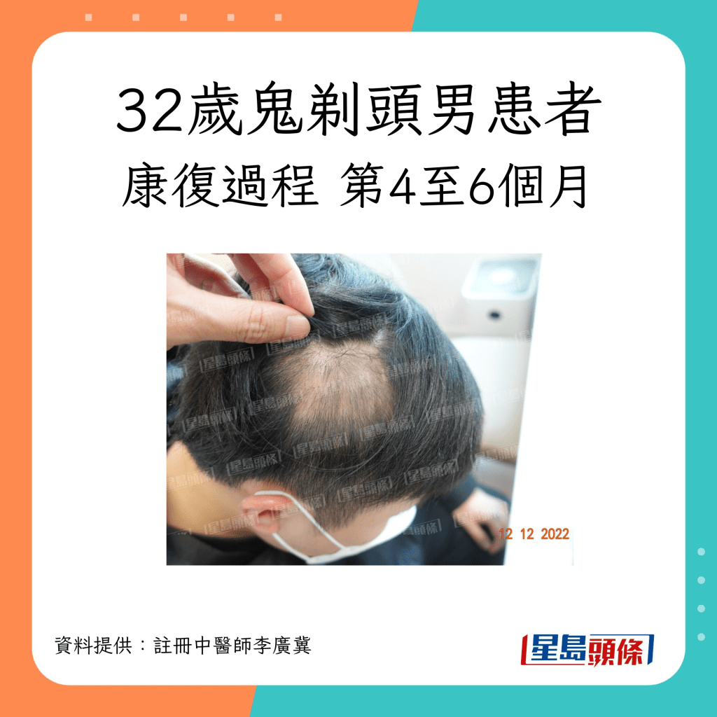 32歲脫髮（鬼剃頭）男患者康復過程，經中醫治療第4至6個月