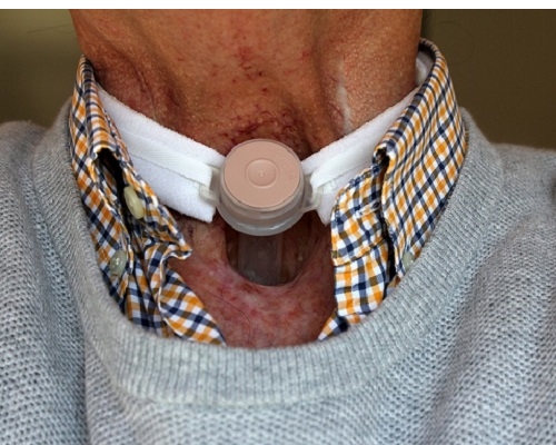 曾某因聲帶退化，而真的無法再說話。 示意圖