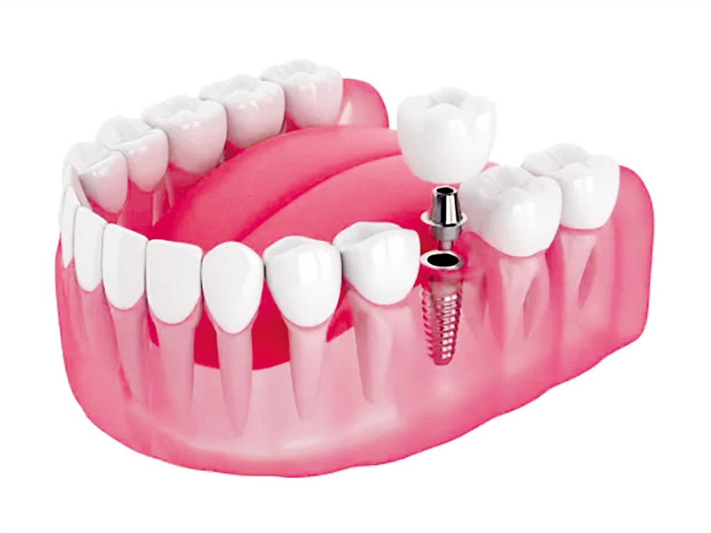 植牙可根據植入時機,分為傳統植牙與即時植牙。 植牙可根據植入時機,分為傳統植牙與即時植牙。