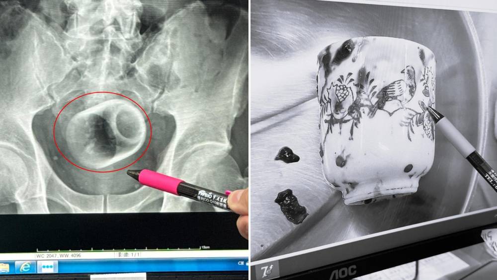 台男肛門塞6cm陶瓷杯，3天無法排便，終開刀取出。 李綜合醫院