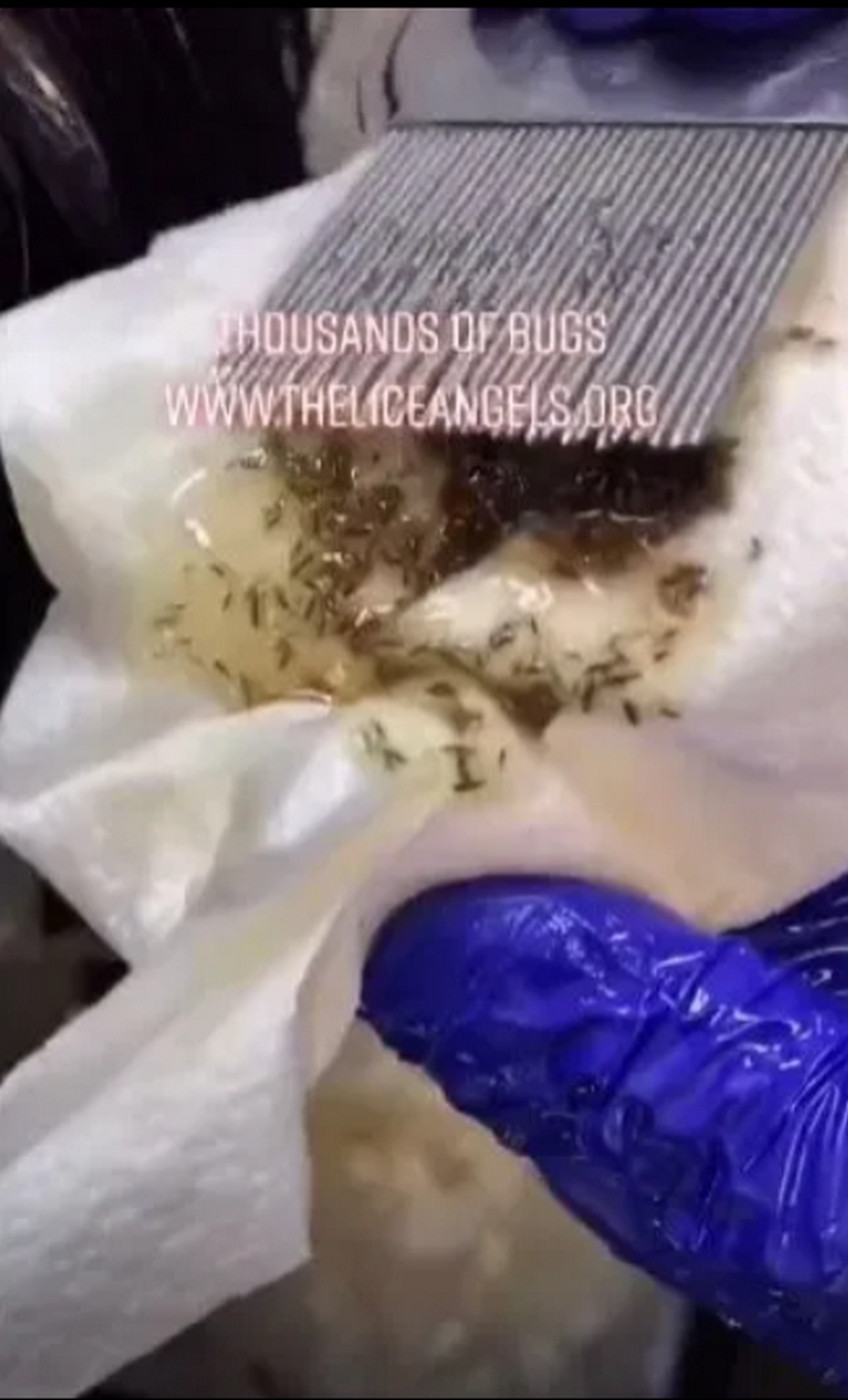 工作人員用梳刷出大量頭蝨。網上截圖
