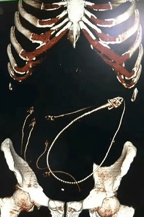 男子腹部的扫描图，显示有一条鳗鱼。FB图