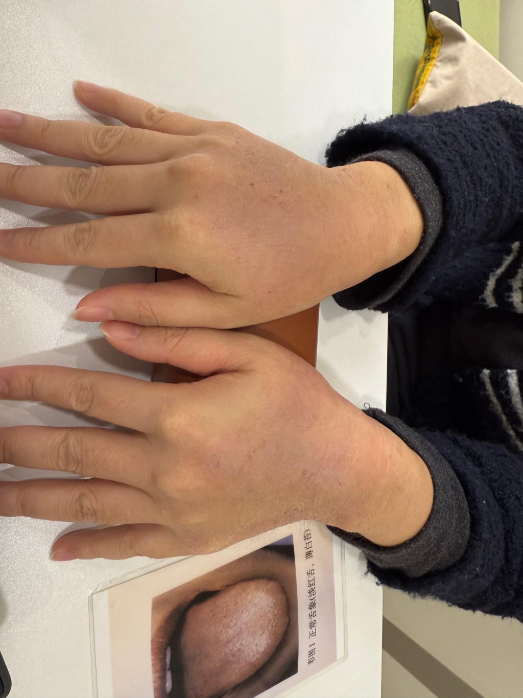 经中医中药和针灸治疗，林女士渡过「托毒外透」阶段，湿疹逐渐消退。（注册中医师陈嬿珺提供）