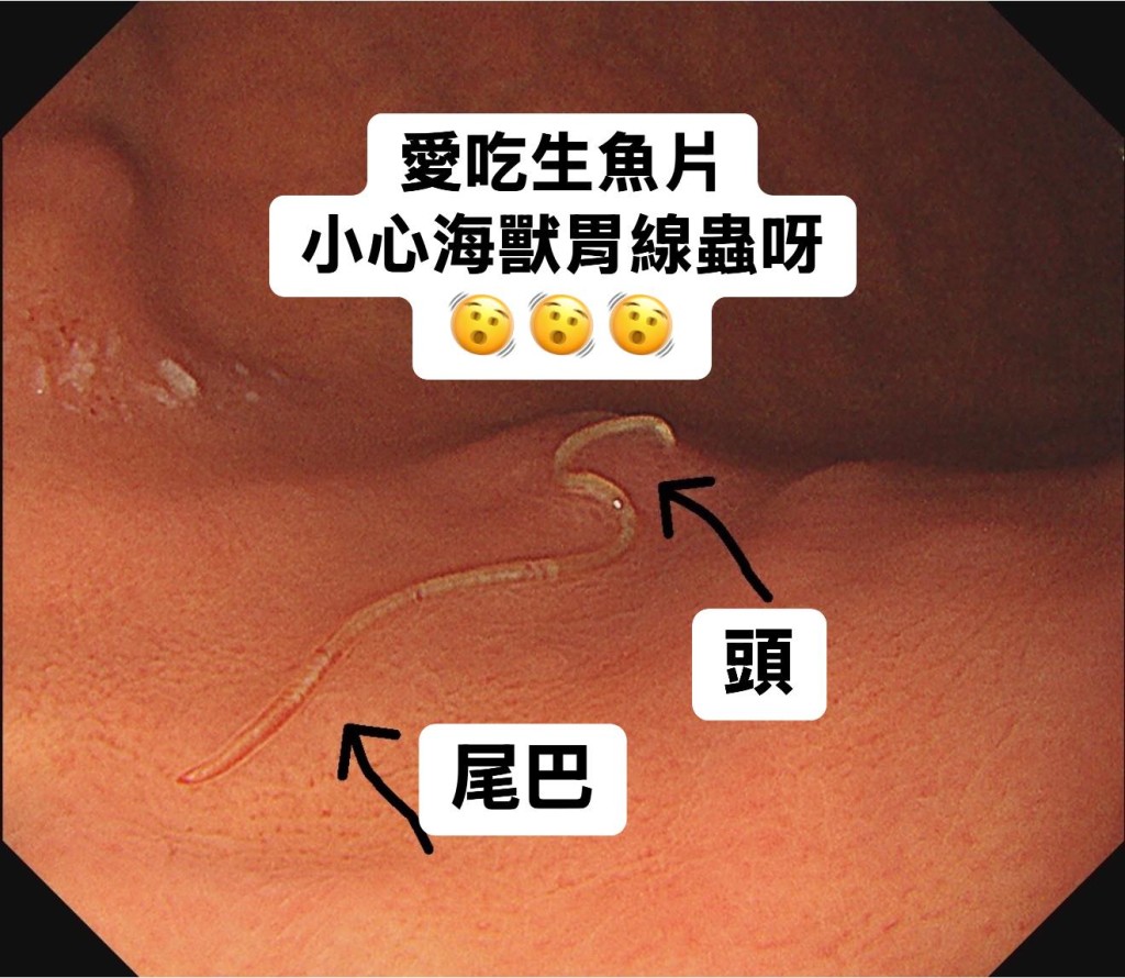 该名50岁患者持续胃痛，经检查后发现胃部寄生虫「海兽胃线虫」。（相片获胃肠肝胆科医生林相宏授权转载）