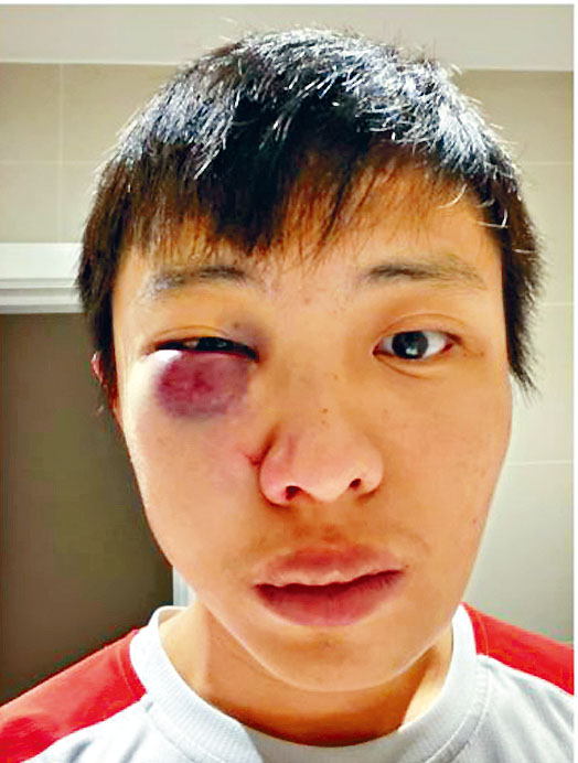 莫顯強在facebook發布的照片可見其臉部受傷，眼睛紅腫。