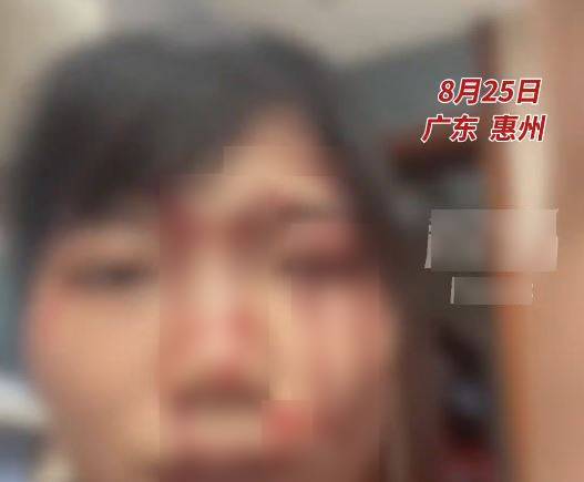 陳小姐被男同事掟杯襲擊,導致臉部重創要縫逾20針毀容。抖音 陳小姐被男同事掟杯襲擊,導致臉部重創要縫逾20針毀容。抖音