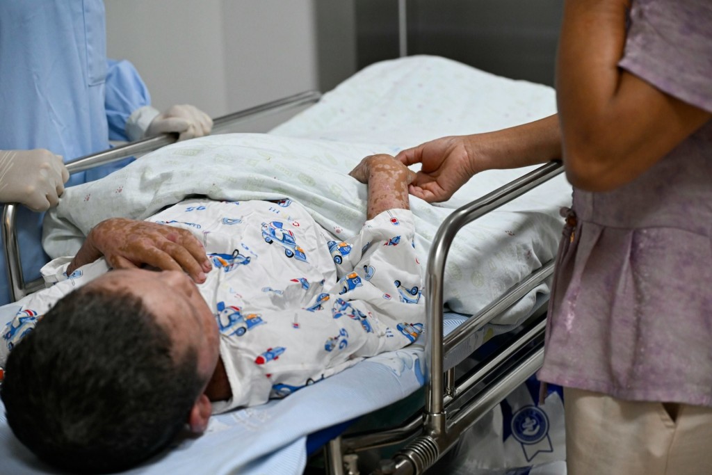 小輝因罕見的毒性表皮壞死溶解症，全身八成皮膚剝落。極目新聞