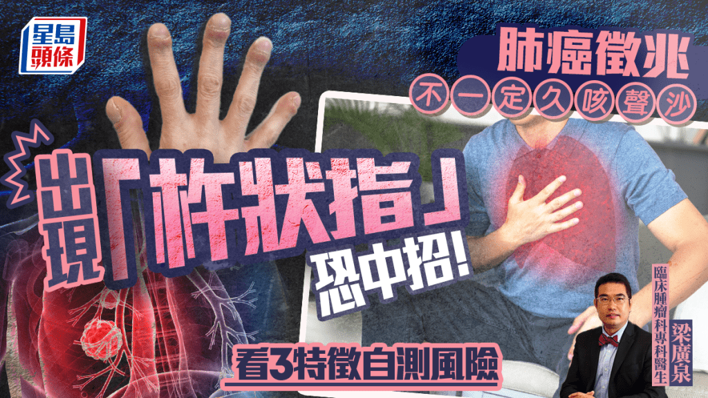 父親節保健|肺癌徵兆不一定久咳聲沙 出現「杵狀指」恐中招 醫生教看手指3特徵自測風險