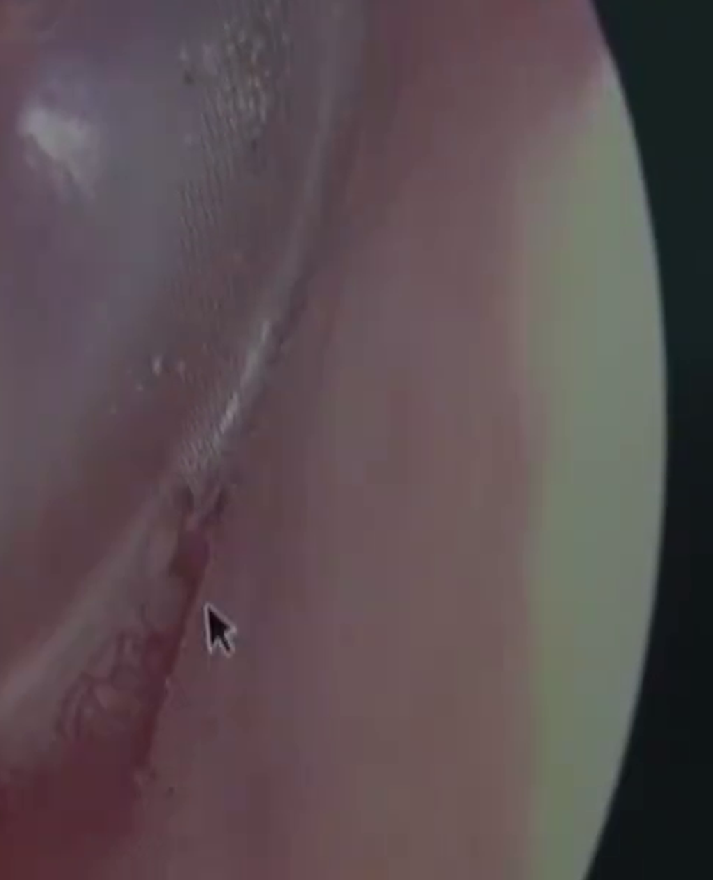 医生用耳镜发现有活虫在女病人耳中爬行。