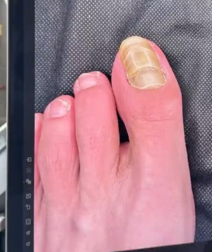 穿襪睡覺睡出「千層甲」。三農頻道