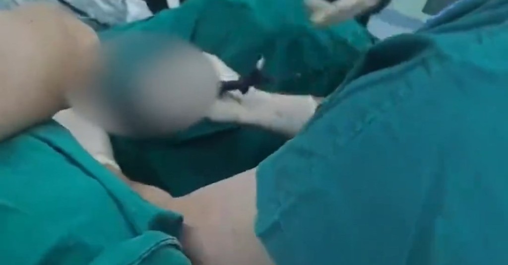 醫生從小余下體抽出177克異物。《南方都市報》