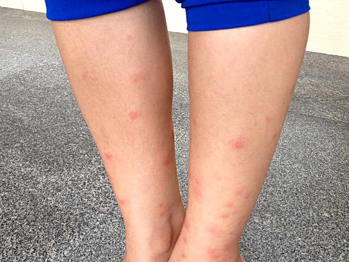 蠓多集中咬腳。網圖 