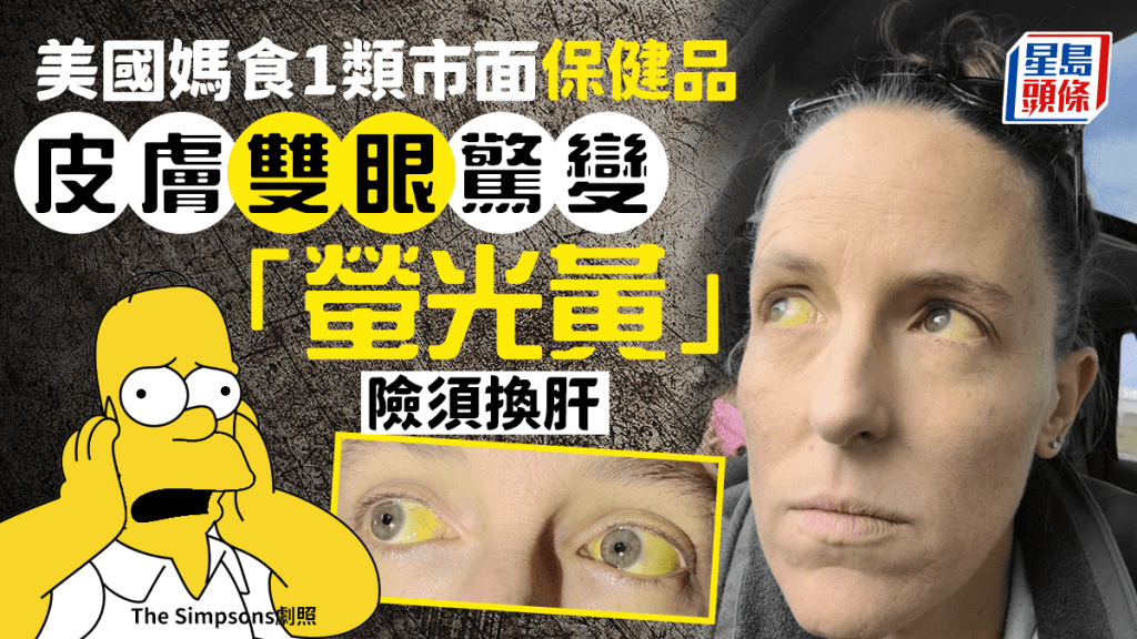 4寶媽食某種草藥保健品治更年期 雙眼變「螢光黃」險要換肝