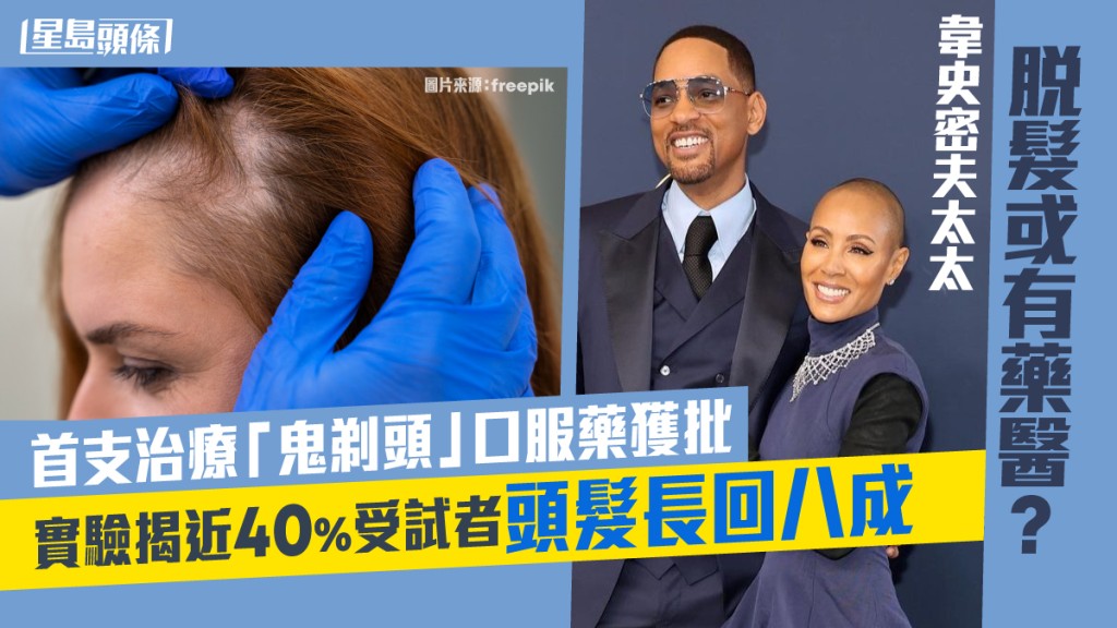 據統計,全美目前每年有逾30萬人受斑禿困擾,其中荷里活男星韋史密夫(Will Smith)太太Jada Pinkett Smith亦是患者之一。