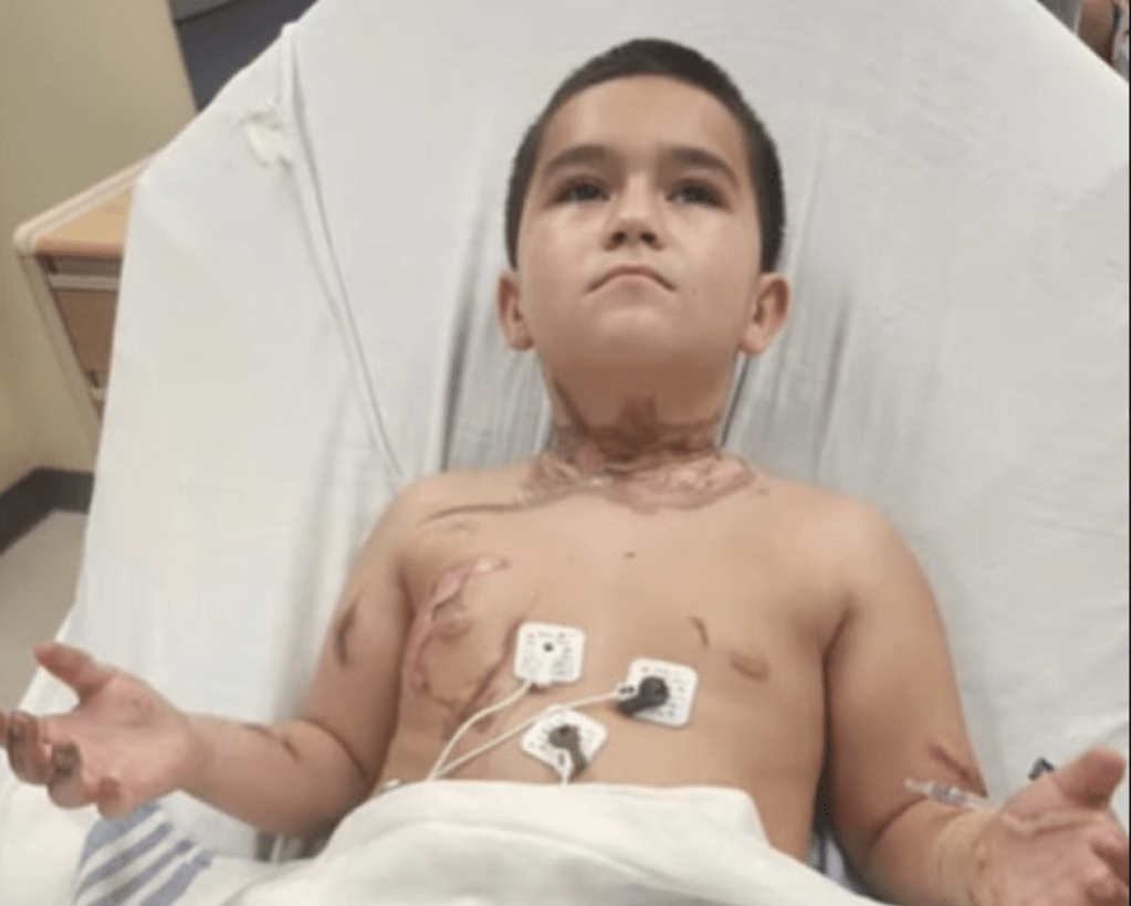 Lorenzo Lopez身上被電流灼傷的疤痕令人悚目驚心。Kourtney Pendleton Facebook（下同）