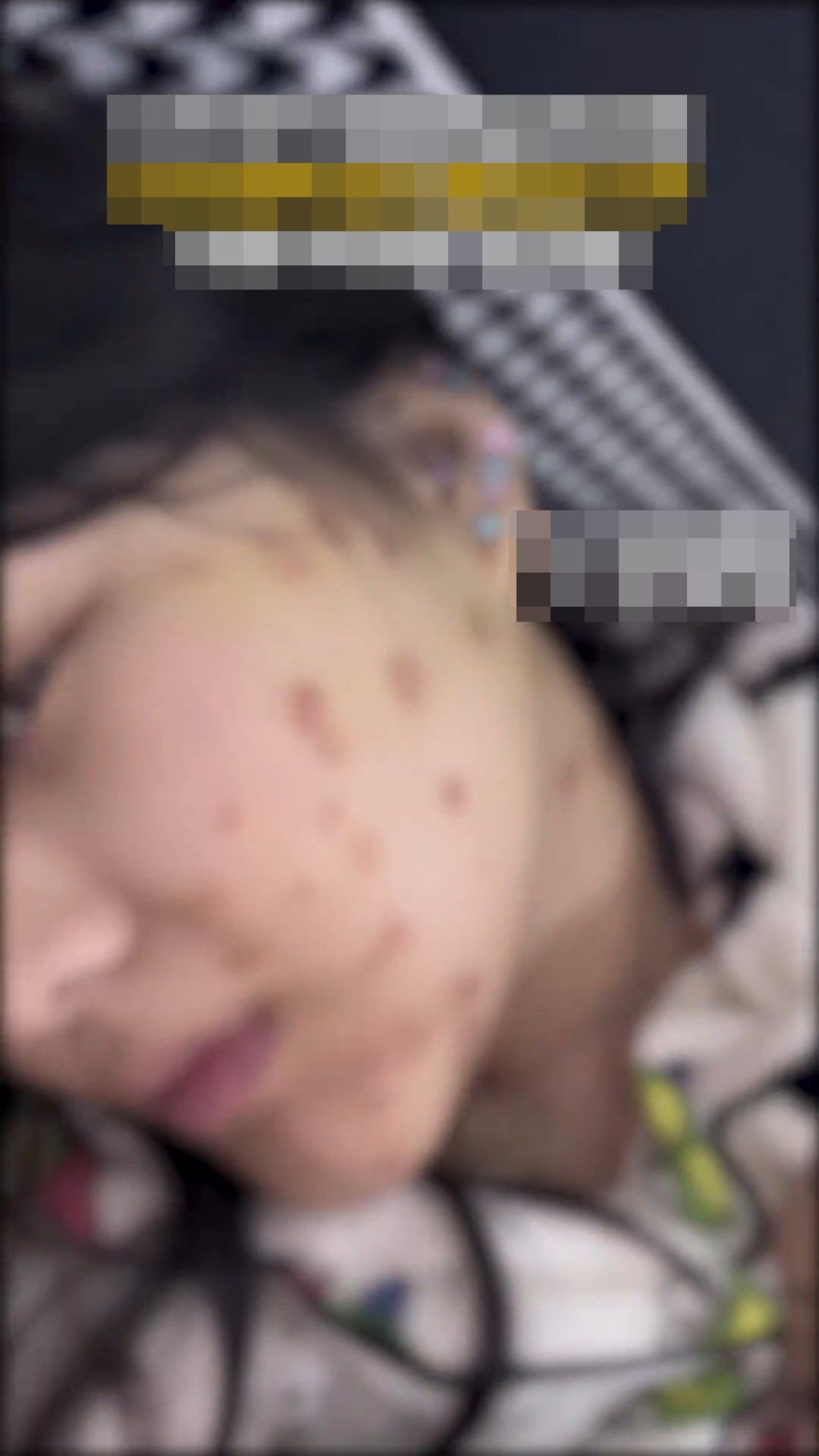 事主被感染貓癬，全身出現紅疹。微博@小莉幫忙