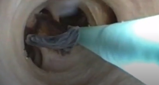 醫生隨即進行手術(圖片來源:新英格蘭醫學期刊)