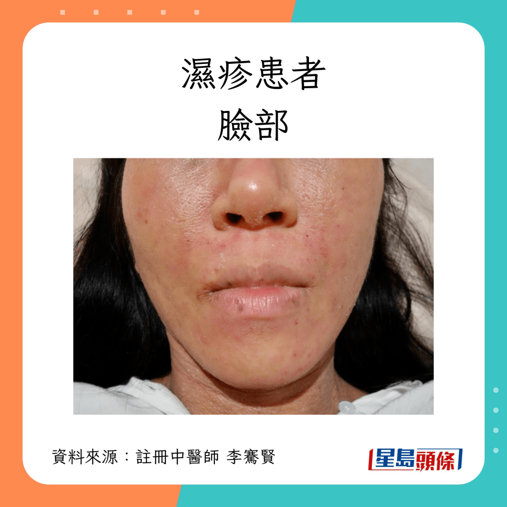濕疹患者臉部康復過程