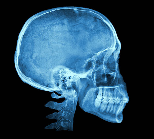 从医学角度，当时哈桑的头与椎骨其实已经分离，即头已在内部断了。示意图/非新闻图片