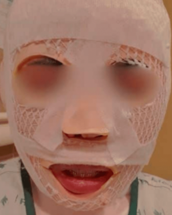 南韓一名當地男子懷疑泰籍妻子出軌，竟趁她熟睡時，將滾燙的熱水潑向其臉部及頸部，導致妻子全身多處二度燒燙傷。Facebook@NNutt AAomsin
