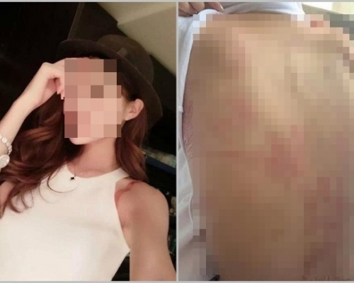 黃伶全身多處被嚴重燒傷。網圖
