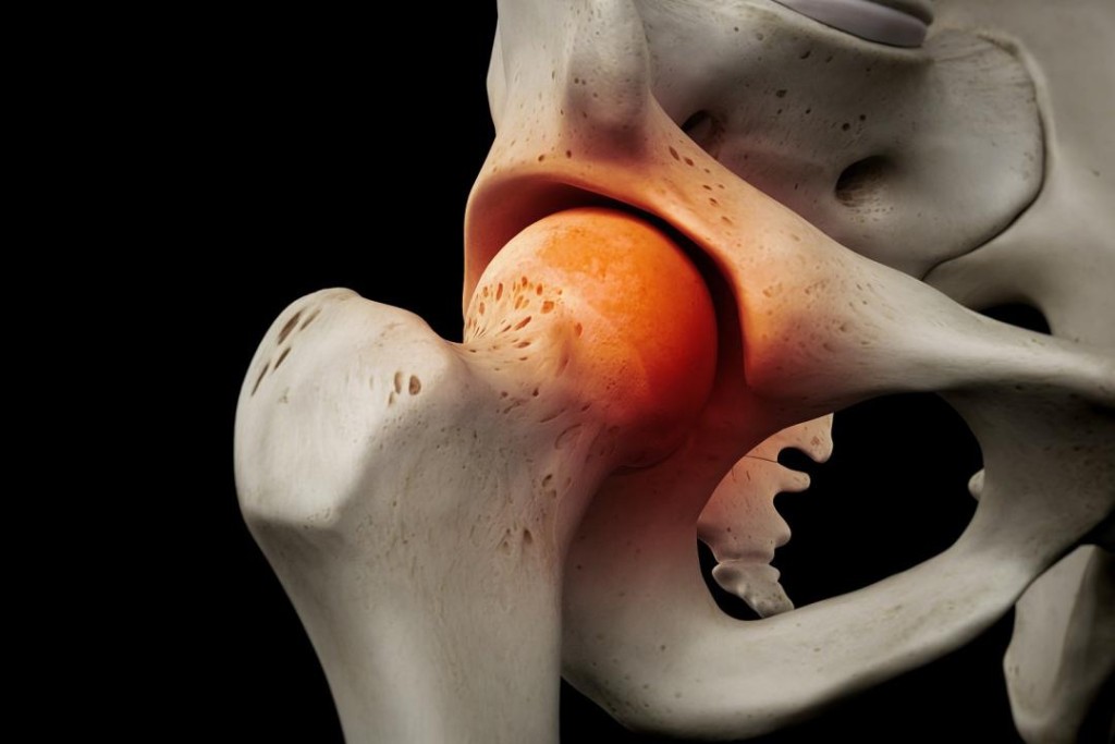 髖關節問題不可忽視。筆者提供圖片 髖關節問題不可忽視。筆者提供圖片