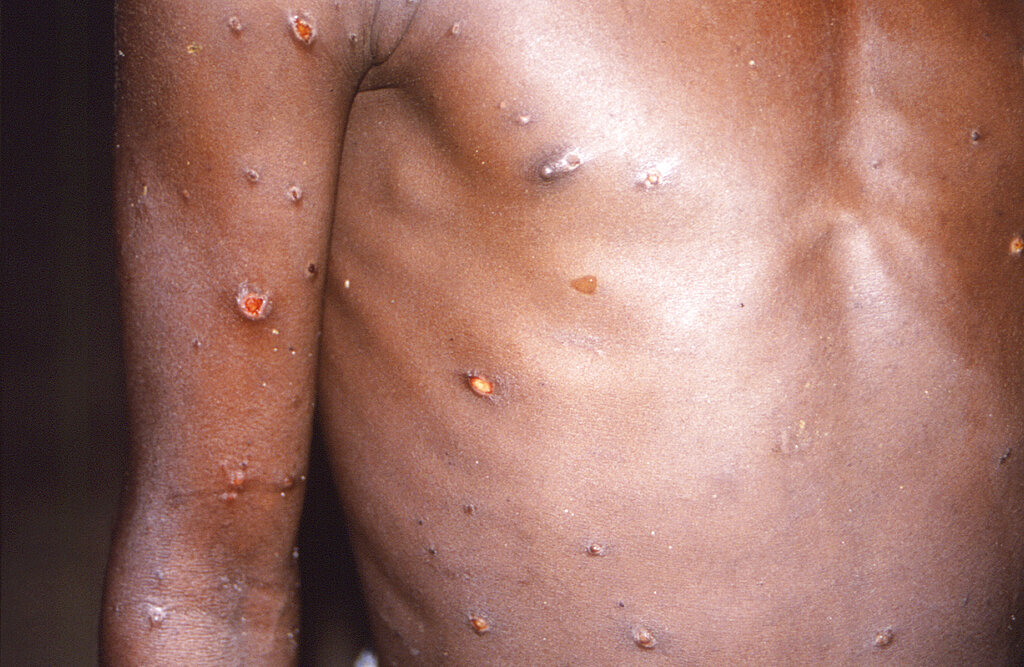 猴痘感染病徵。AP圖片