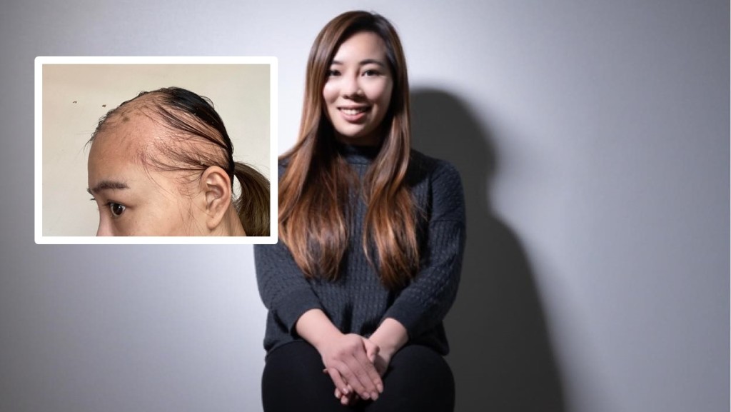 王卓雅早前患上斑禿。王卓雅fb