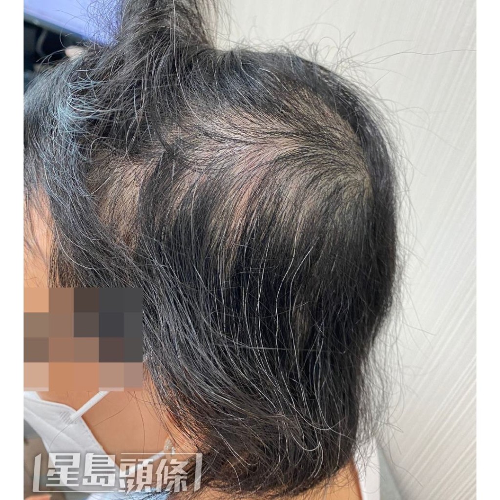 該患者出現「鬼剃頭」，後腦、兩側髪鬢位置的髮量減少30%，令她自信心低落。（相片由註冊中醫師李灼梅提供）