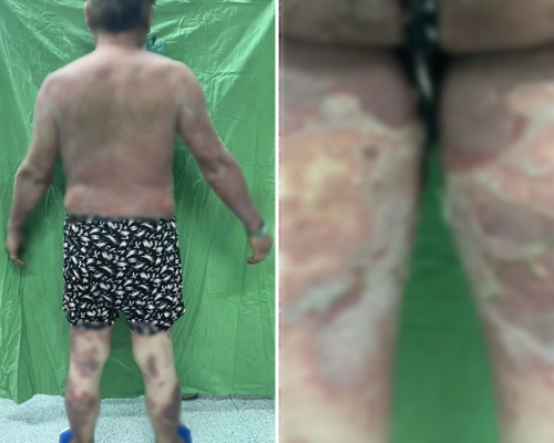 澎湖一名70歲男子接種新冠疫苗後，出現全身脫皮不良反應。網圖
