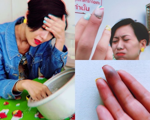 趙學而去旅行被車門夾中指，睇相都覺得好痛吖。