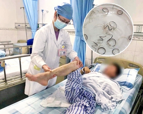 深圳男子長年喝生水,腦中長滿寄生蟲。網圖