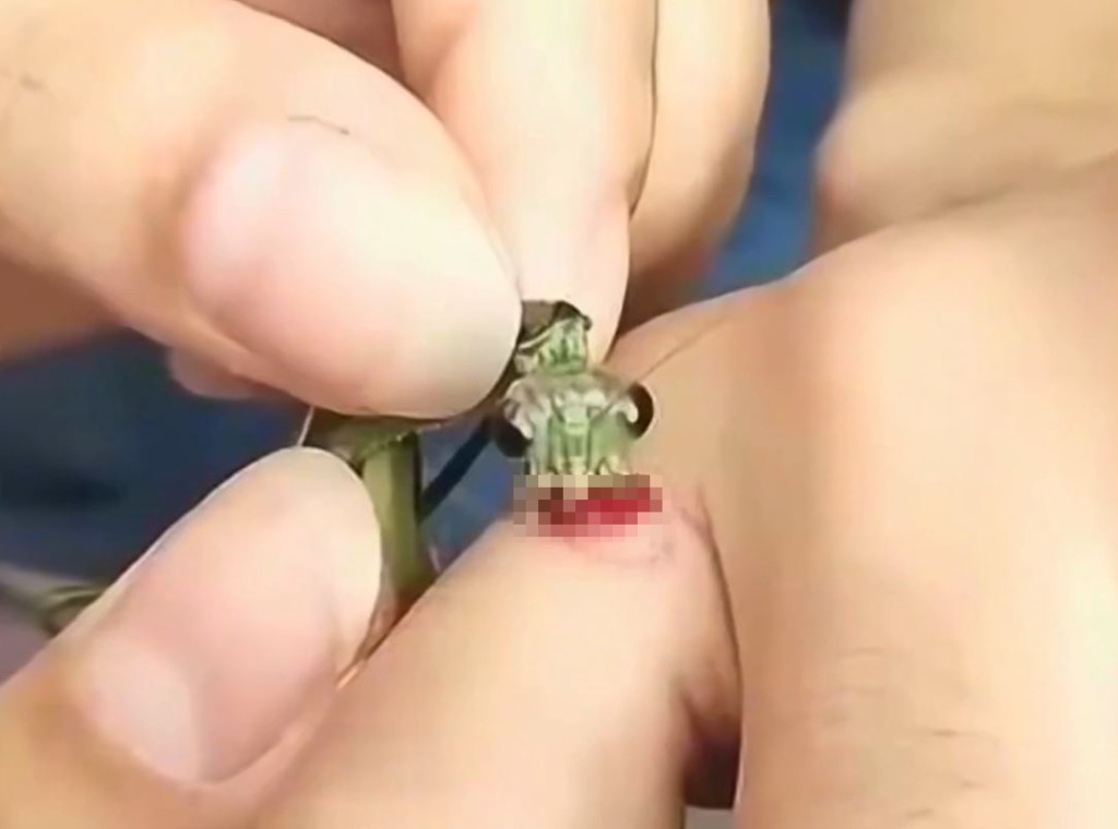 医生警告，用螳螂来食颈疣有感染风险。影片截图
