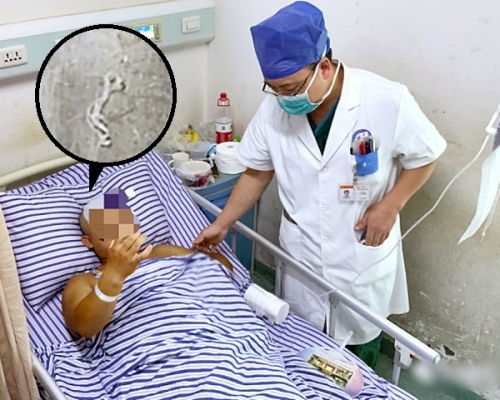 醫生從男子腦內取出一條12厘米長寄生蟲。網圖