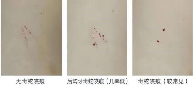 不同蛇类的咬痕。深圳急救中心 不同蛇类的咬痕。深圳急救中心