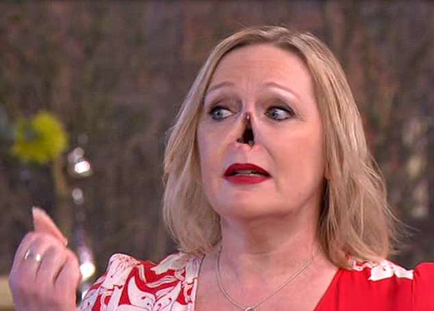 哈德曼因患有自身免疫疾病,導致鼻子組織被侵蝕,開始出現塌下情況。