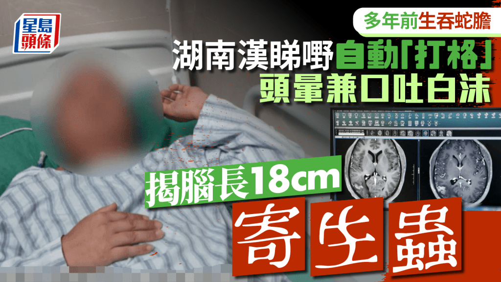湖南漢前生吞蛇膽致腦長18cm活蟲 看東西自動「打格仔」