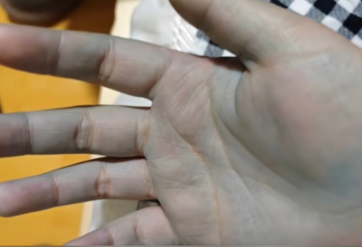 自製網紅美食「牛癟火鍋」，成都一家4口吃完雙手變藍中毒送院。